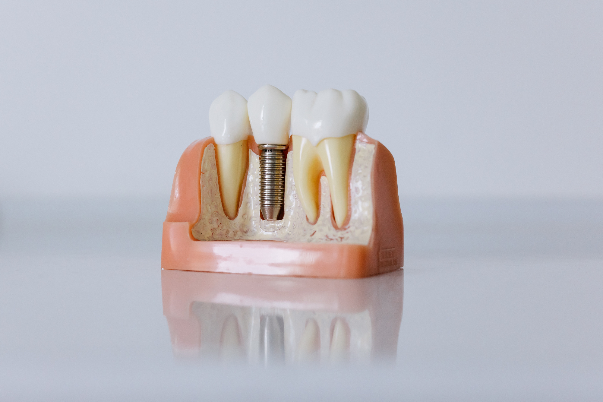 Zobni implantati so izdelani iz izjemno trpežnega materiala